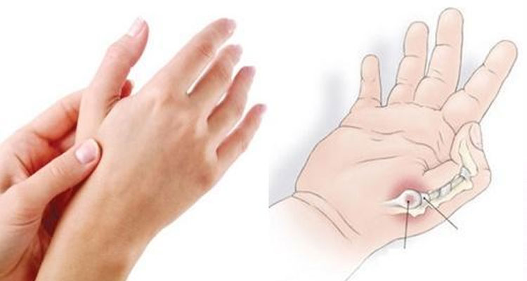 Bệnh viêm xương khớp tại bàn tay là một trong những nguyên nhân hàng đầu gây tình trạng đau khớp ngón tay