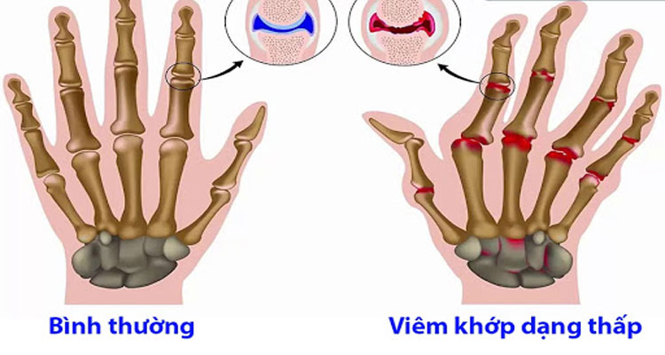 Bệnh diễn ra phổ biến nhất là đầu ngón tay và khớp nối giữa các ngón tay.