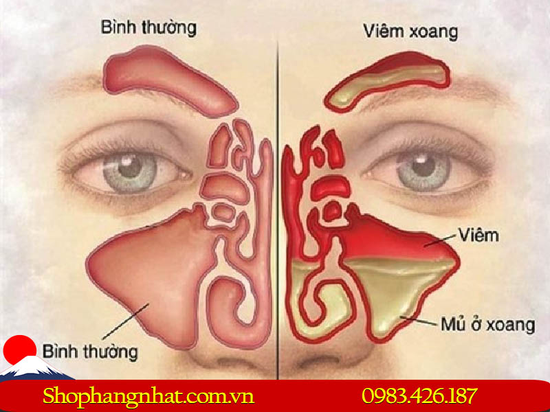 Viêm xoang là tình trạng viêm nhiễm các xoang cạnh mũi do tác nhân vi sinh vật từ bên ngoài vào