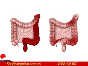 phân biệt viêm đại tràng và viêm đại tràng co thắt mãn tính